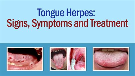 tongue hermes|how to prevent tongue herpes.